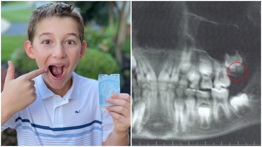 Split image of Ryan Scarpelli holding his wisdom tooth and smiling and image of an x ray of Ryans mouth
